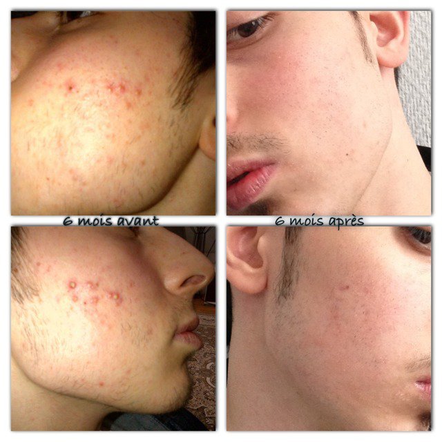 Roaccutane Creme Sans Ordonnance