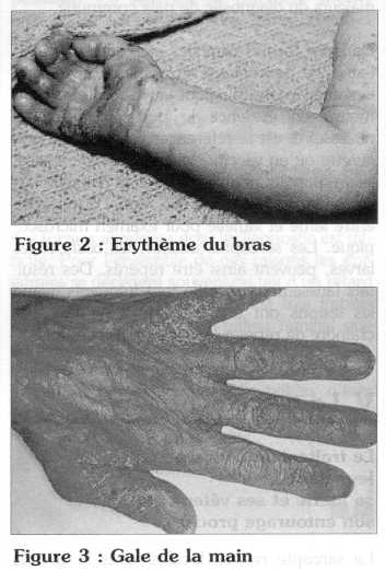 Stromectol gale sans ordonnance