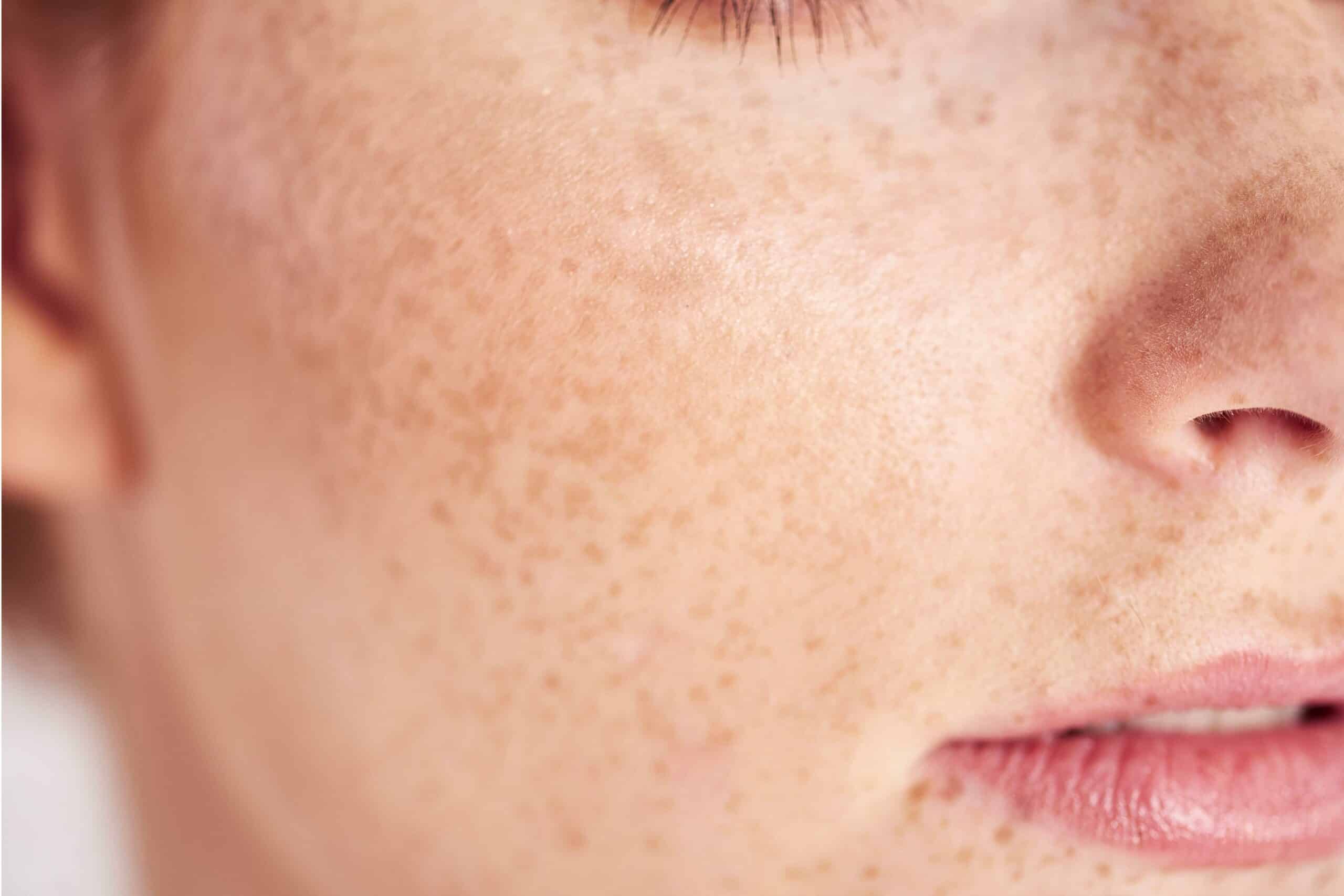 Roaccutane Gel Prix Remboursement