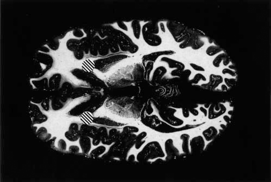 sertraline 50mg bnf