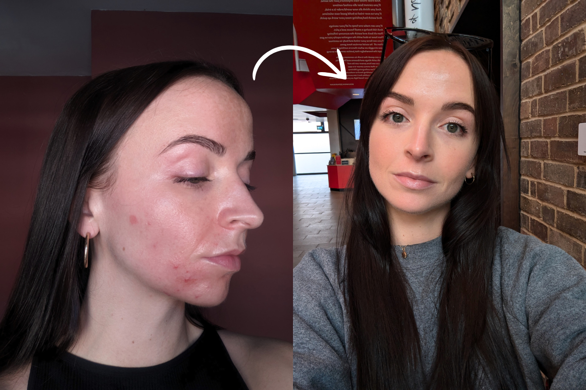 Commander Accutane