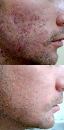 Prix Roaccutane Pharmacie