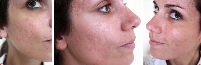 Roaccutane Quelle Pilule