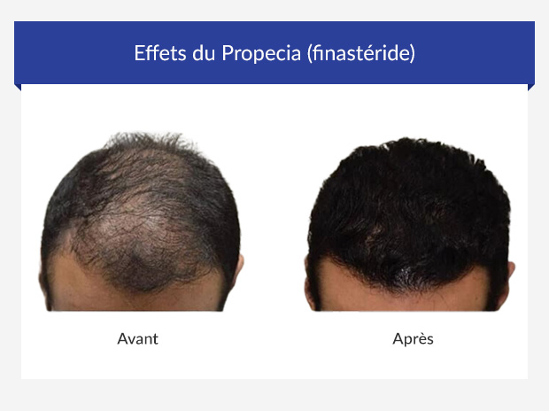 Acheter Du Finastéride Générique
