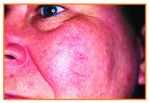 Isotrétinoïne 5mg Achat