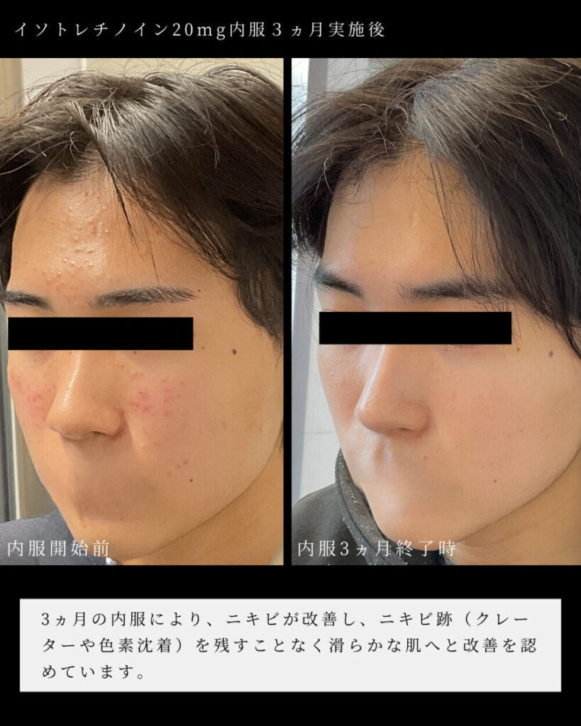 Accutane Online Eu