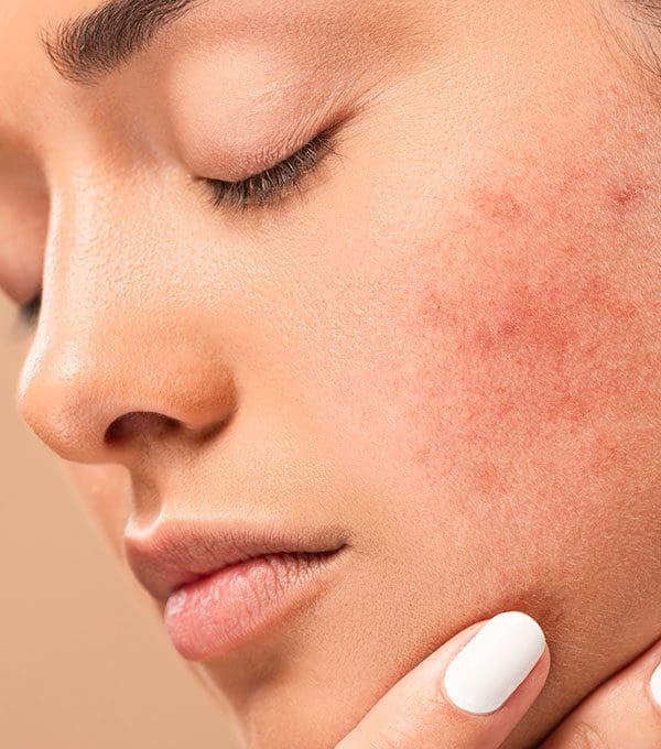 Coût Accutane