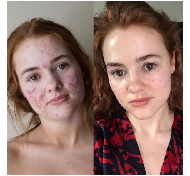 Pilule Sous Roaccutane