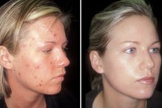 Accutane 5mg Online