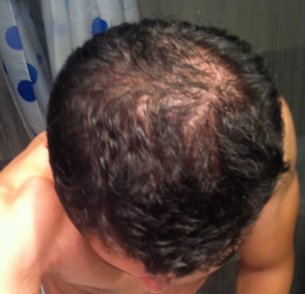 Finasteride Generique Avis