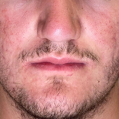 Isotretinoin Pilule