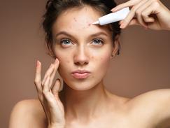 Roaccutane Pommade Prix