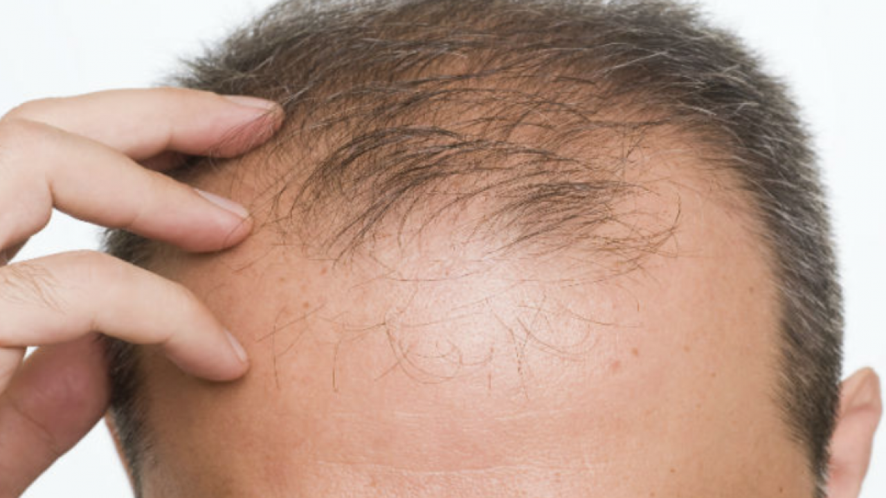 Finasteride Pilules