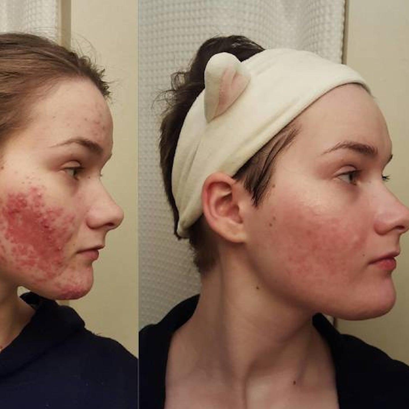 Accutane 10mg