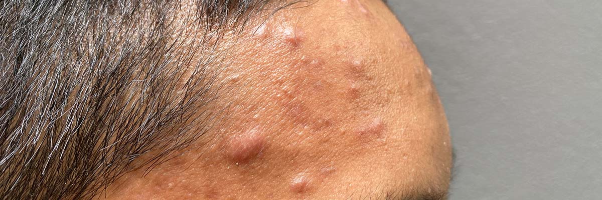 Accutane Comment Acheter