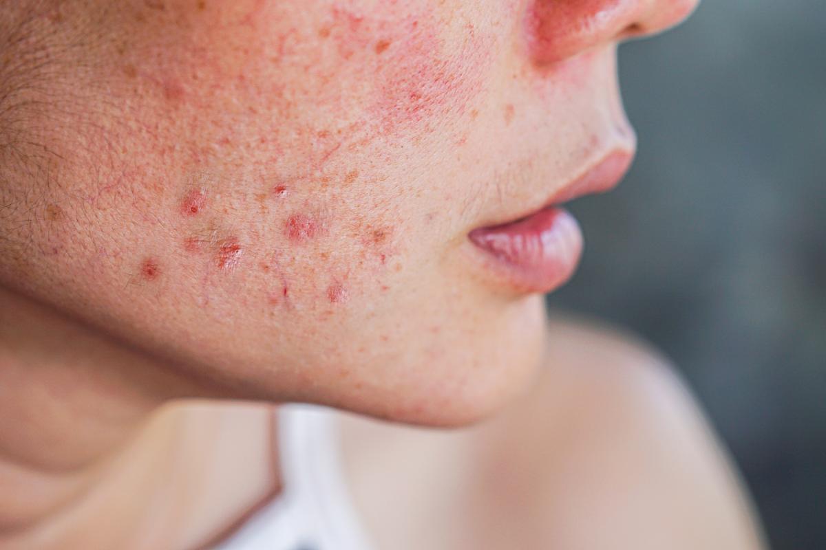Accutane France