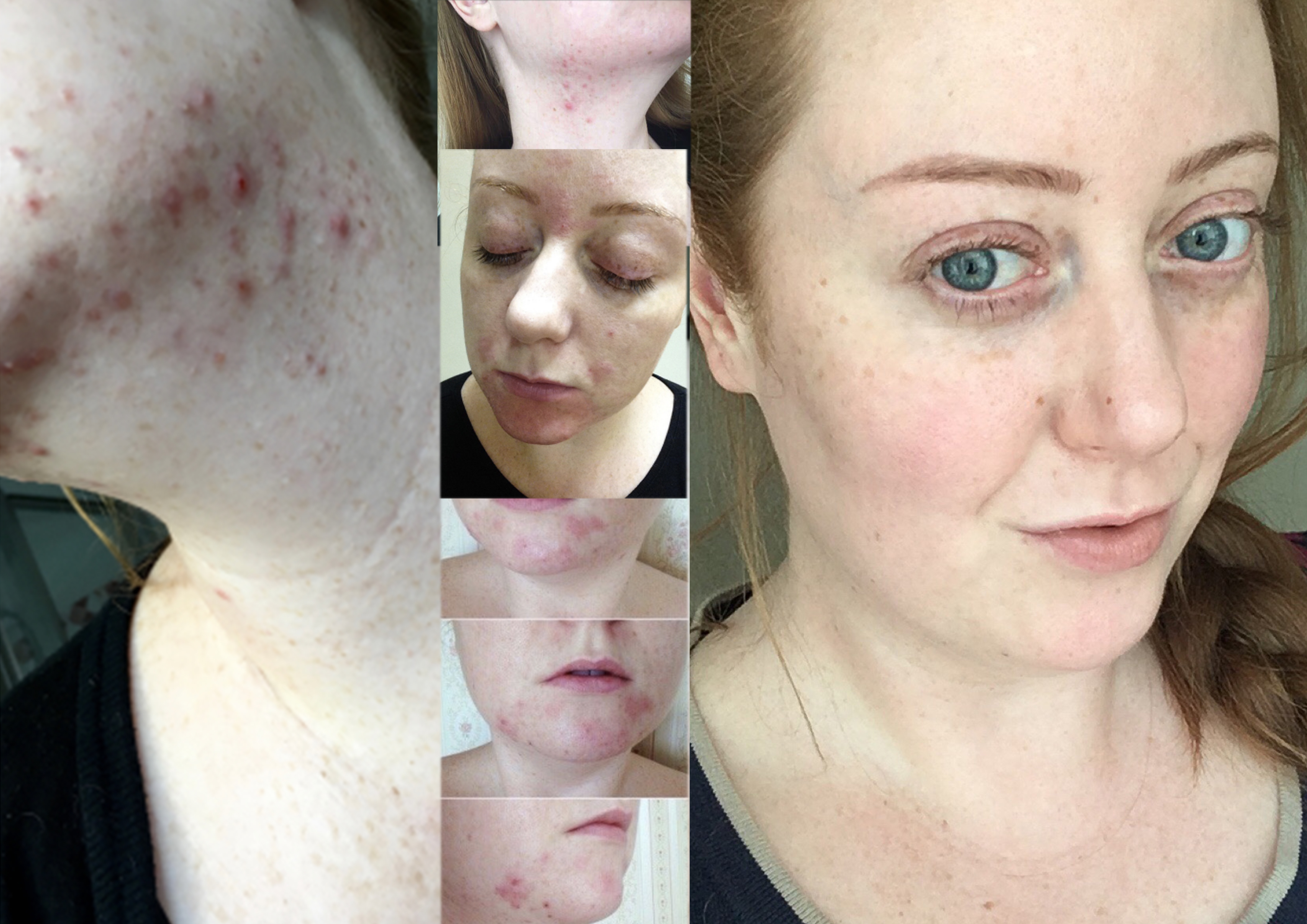 Accutane Nom Generique
