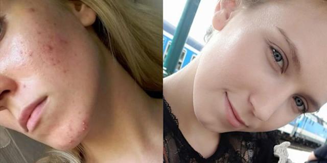 Accutane Sans Ordonnance