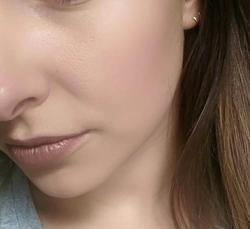 Roaccutane Apres Arret Pilule