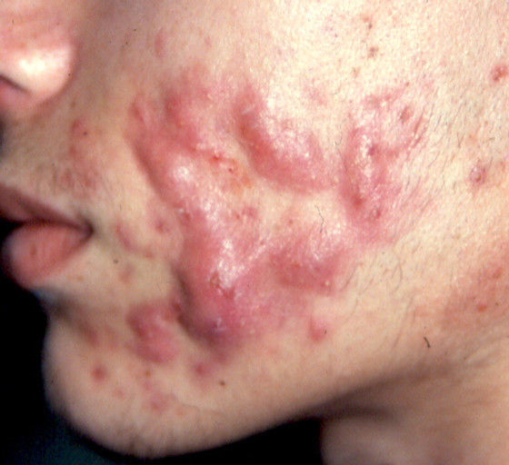 Roaccutane Acheter Ligne