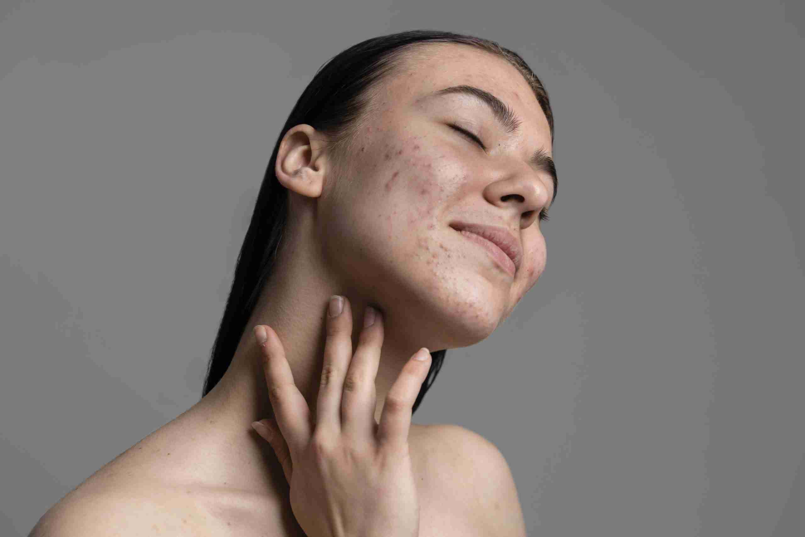Roaccutane Sans Pillule