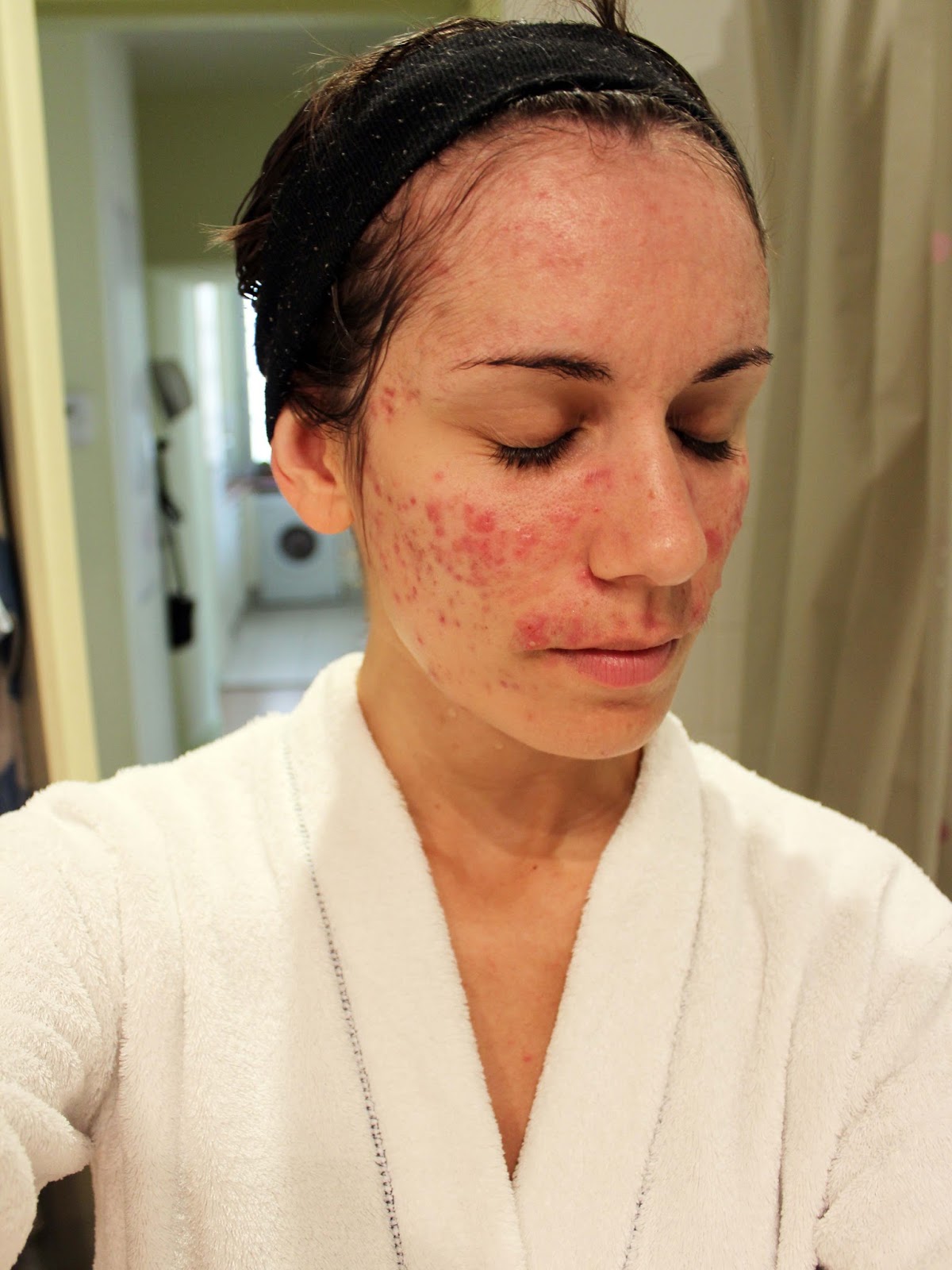 Roaccutane Pas Cher