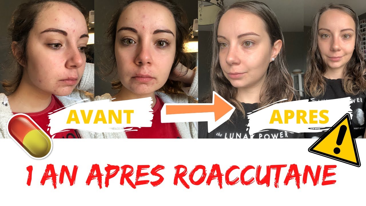 Coût Roaccutane