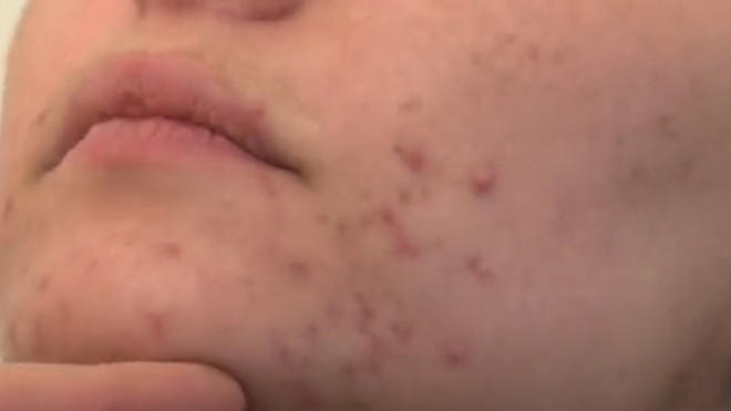 Roaccutane Sans Contraception