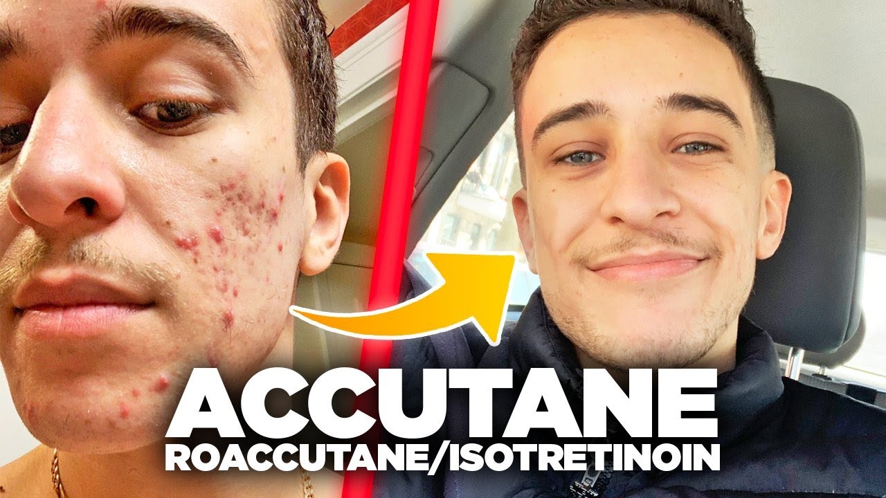 Acheter Du Roaccutane En Ligne