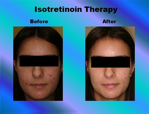 Accutane 40mg Online