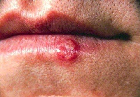 zovirax lip prix