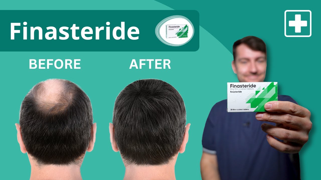 Finasteride 1mg Farmacia Online