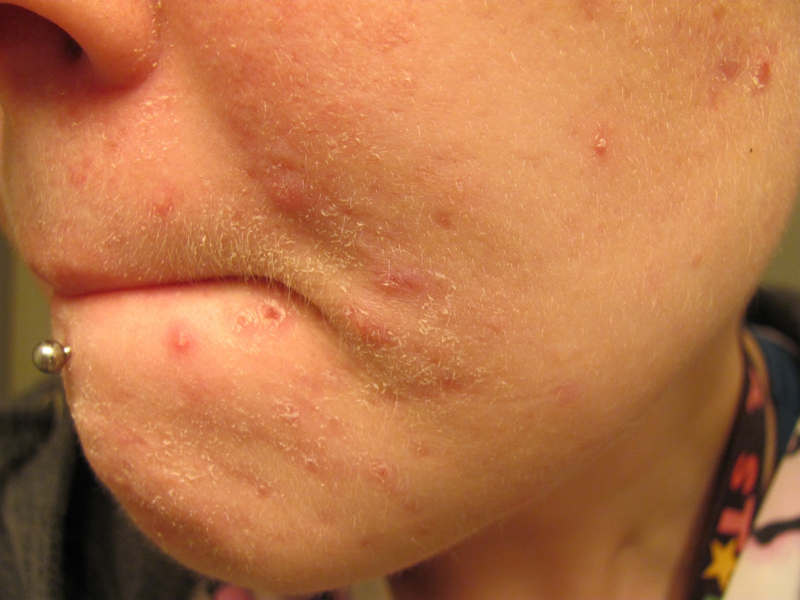 Isotretinoin 5mg