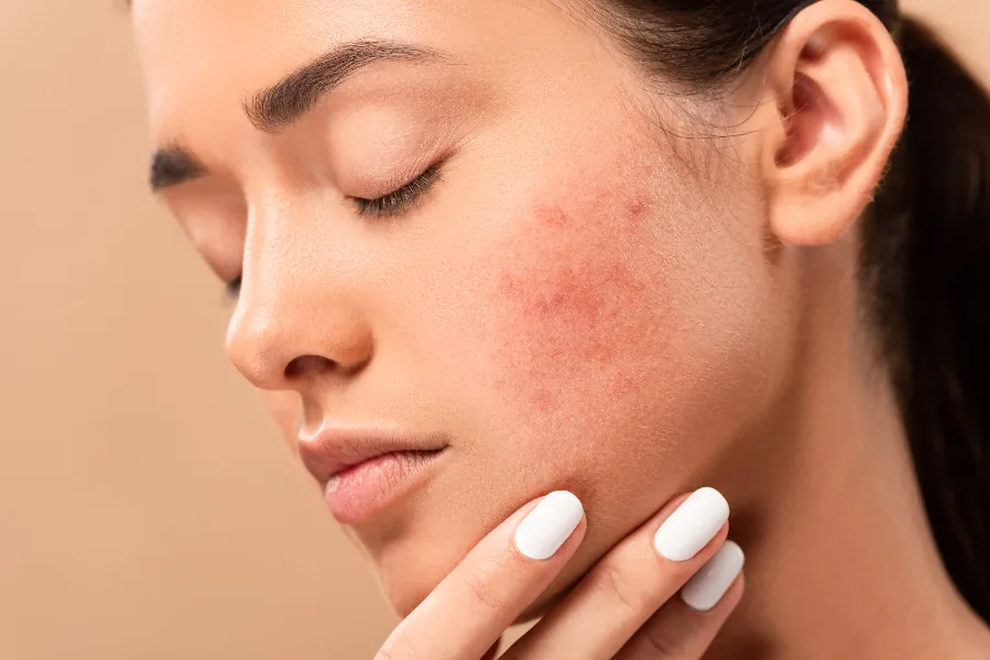Pilule Apres Roaccutane