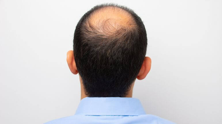 Prix Finasteride Bailleul