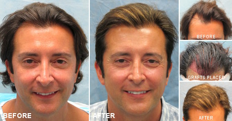 Propecia Finasteride Prix