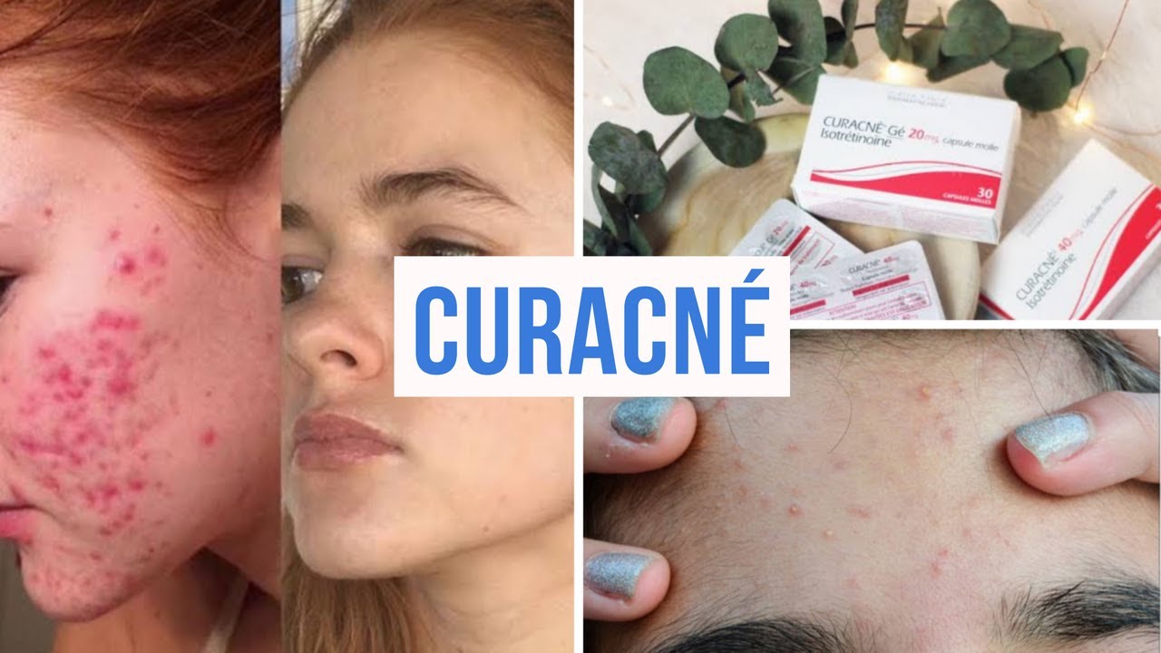 Roaccutane 10mg