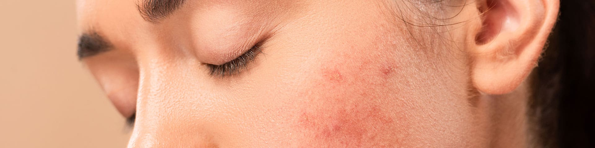 Roaccutane Acheter Online