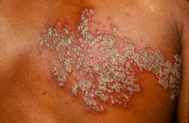 Valacyclovir france